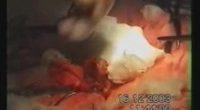 Colon Cancer Surgery 