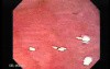 Tubulo-Villous Adenoma (2 of 6)