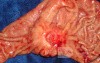 Diffuse Adenocarcinoma with signet ring cells (14 of 18)