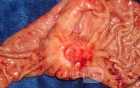 Diffuse Adenocarcinoma with signet ring cells (14 of 18)