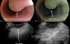 Esophagel leiomyoma of the "mucularis mucosae"