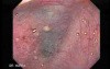 Esophageal Diverticula - Searching for the Diverticulas