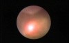 Ureterolithotripsy