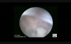 Hysteroembryoscopy Observation Of  The Pregnancy Sac