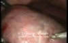 Segment Liver resection - Laparoscopic Approach
