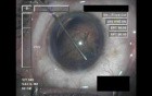 Cataract Surgery VI - Part 1