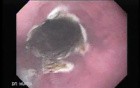 Barrett's Esophagus of long segment (9 of 11)