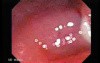 Inespecific Diverticulitis (2 of 4)