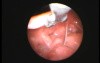 Fishbone Removal - Transnasal Fiberoptic Approach