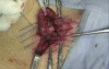 Indirect hernia repair