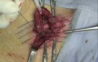 Indirect hernia repair