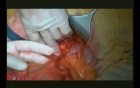 Right Open Hemicolectomy – Technical Principles - Part 2