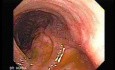 Consecutive colonoscopy with dilation was carried out (15 of 15)