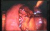 Jejunal Gastrointestinal Stromal tumor (GIST) (26 of 86)