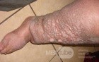 Elephantiasis nostras verrucosa on the legs with morbid
 obesity (3 of 5)