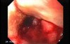 Synchronous Cancer Gastric and Esophageal (8 of 9 )