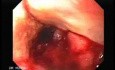 Synchronous Cancer Gastric and Esophageal (8 of 9 )