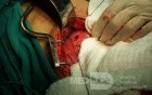 Perforated Gastric Ulcer