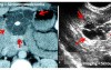 A typical image of pancreatic serous cystadenoma