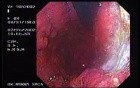 Gastroscopy - Patient With The Epigastric Pain