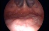 Transoral Nasopharyngoscopy Technique-The View of Nasopharynx