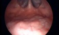 Transoral Nasopharyngoscopy Technique-The View of Nasopharynx