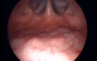 Transoral Nasopharyngoscopy Technique-The View of Nasopharynx
