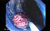 Juvenile Non Familial Polyposis of the Colon (28 of 37)