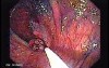 Sessile Tubulovillous Adenoma (9 of 13)