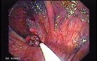 Sessile Tubulovillous Adenoma (9 of 13)