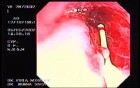 Zollinger- Ellison Syndrome - Gastric Ulcer with Gastrocolic Fistula (12 of 21)