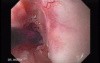 Colonic Interposition for Esophageal Substitution (2 of 11)