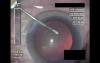 Cataract Surgery IV - Part 1