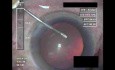 Cataract Surgery IV - Part 1