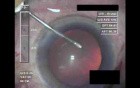 Cataract Surgery IV - Part 1