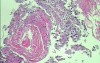 Palliation of Dysphagia of Esophageal Cancer by Endoscopic Lumen Restoration with Intraluminal tumor Debulking (16 of 18)