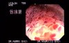 Large Villous Adenoma of the Sigmoid