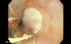 Upper GI Bleeding Due to Esophageal Varices - Banding of Varices, Part 2