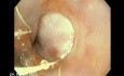 Upper GI Bleeding Due to Esophageal Varices - Banding of Varices, Part 2