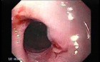 Barrett's Disease - Esophagoscopy