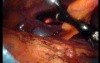 Gastrointestinal Stromal Tumor - GIST (31 of 65)