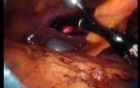 Gastrointestinal Stromal Tumor - GIST (31 of 65)