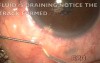 Glaucoma surgery- microtrack filtration