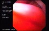 Barrett´s Esophagus (4 of 4)