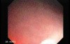 Tubulo - Villous Rectal Adenoma - Endoscopy (3 of 35)