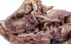 Rectal Adenocarcinoma that infiltrates the second and the 
 third valve (3 of 5)