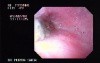 Tubulo - Villous Adenoma - Endoscopy (1 of 28)