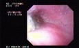 Tubulo - Villous Adenoma - Endoscopy (1 of 28)