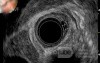 EUS images of the granular cell of the distal esophagus