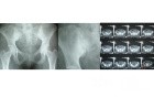 TB Artheritis of Rt. sacroiliac joint
